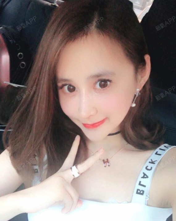 下巴截骨术好不好_效果图_小zz大酱紫下巴截骨术术后第143天_新氧美容