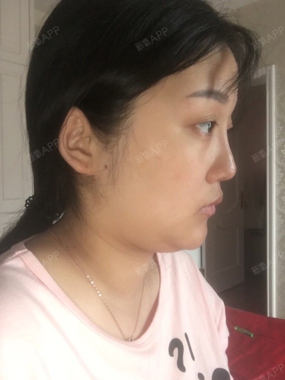 脸上肉肉的婴儿肥双下巴下颌缘脸颊肉都多多的求美女