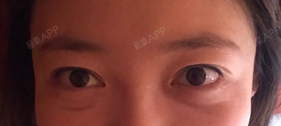 这样的眼袋和泪沟乌青到底怎么办!整个人老了五岁!