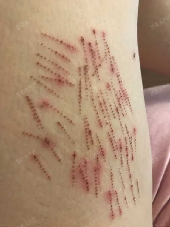 肥胖纹如何去掉