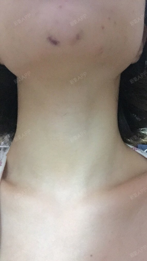 注射完已经一周了 下巴针孔部位还有些淤紫 估计再过一段能消退吧 上