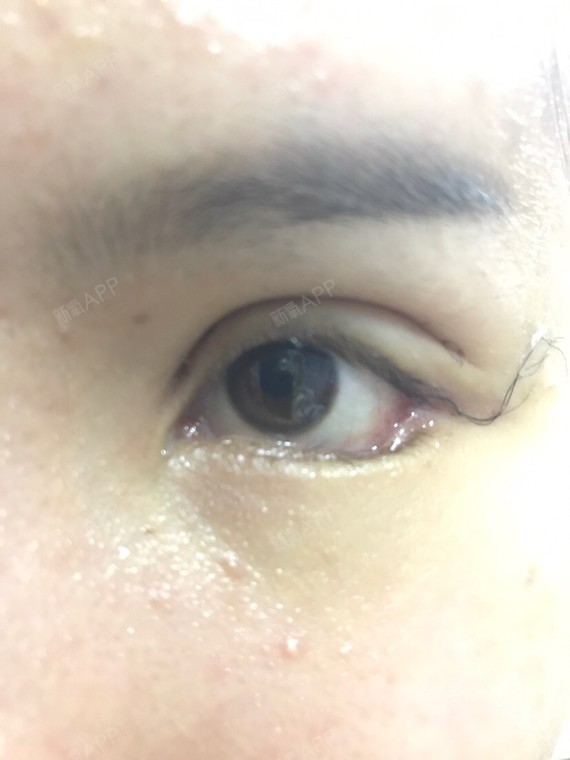 开外眼角好不好_效果图_氧气_uph771770开外眼角术后9