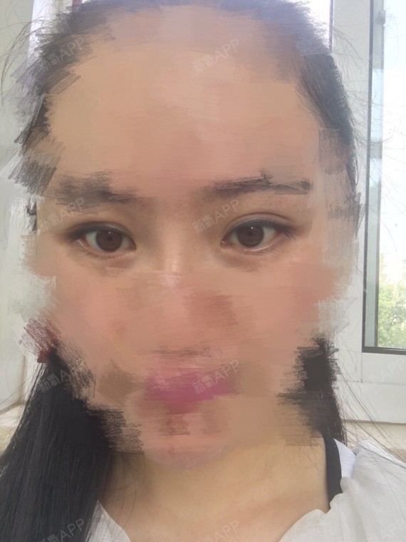 做了双眼皮全切手术,现在一大一小,由于之前是