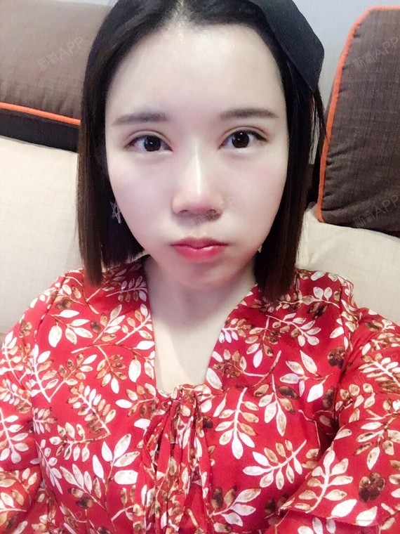 内眼角开大了 双眼皮太宽有明显肉条感