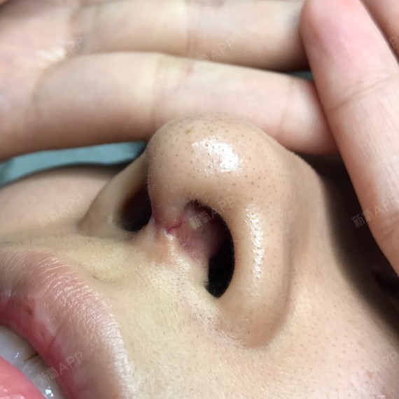 鼻小柱疤痕明显有凹陷还会恢复吗?