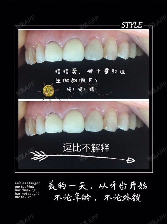 修复的效果:牙齿色泽与临牙相近,形态外观流畅,牙龈边缘无