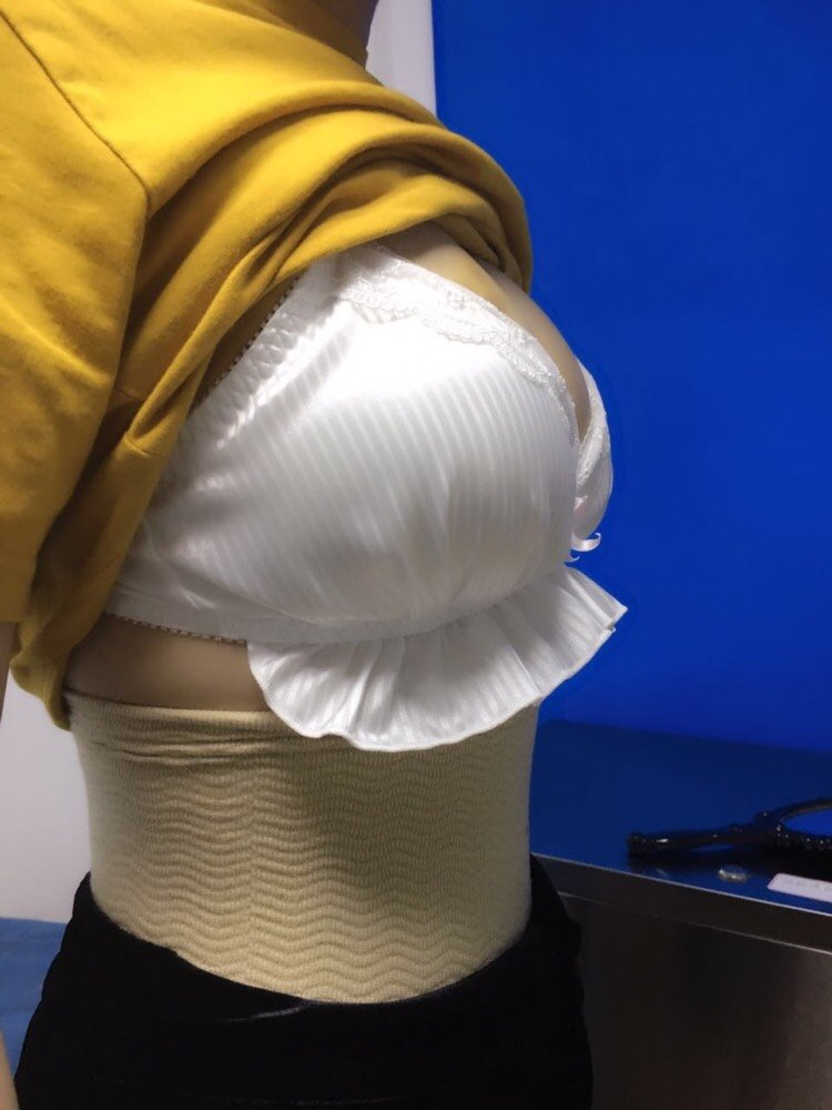 自体脂肪隆胸怎么样_开始对自己真实的美丽日记_新氧