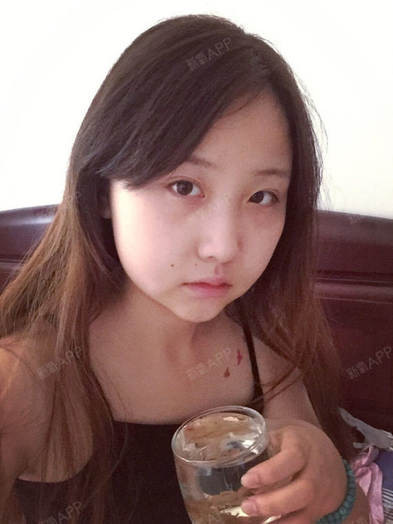 溶脂瘦脸项目术后第4天