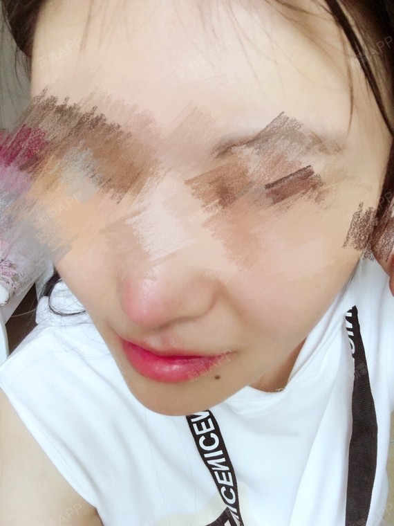 重庆m唇手术好不好_效果图_甜口鳄鱼m唇手术术后第54天_新氧美容整形