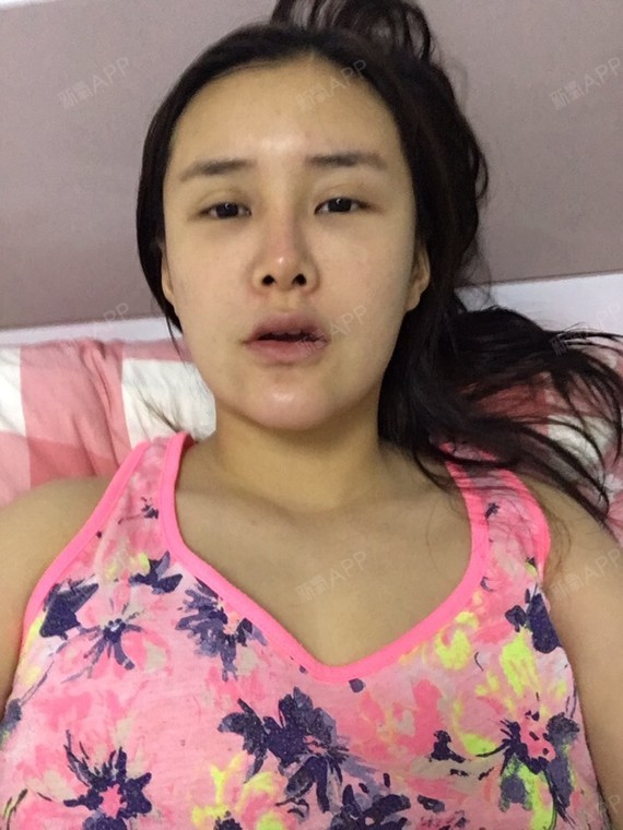 术后半个月,感觉下巴脂肪依旧很多,不知道是不是肿的缘故,假体