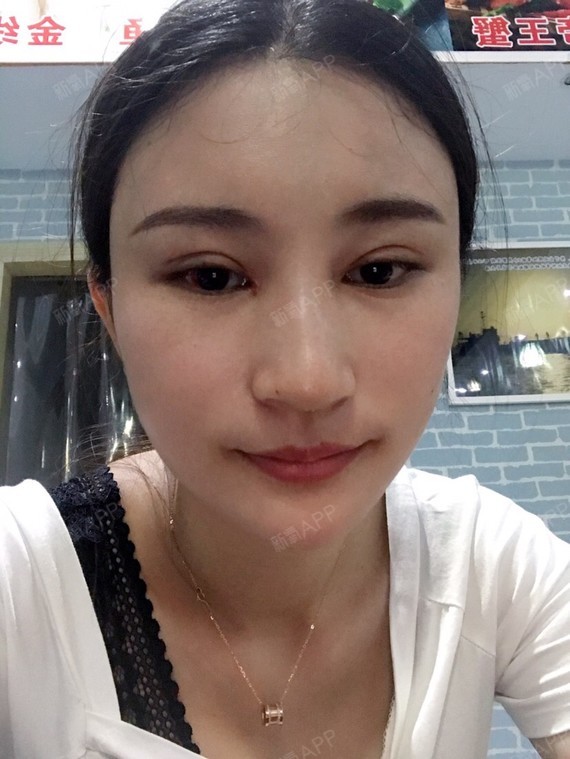 开眼角疤痕增生求恢复方法