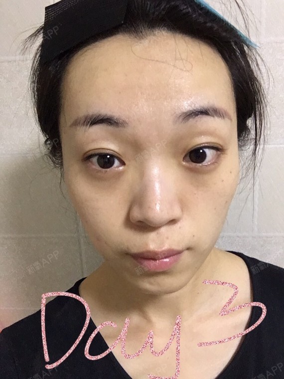 水光针
