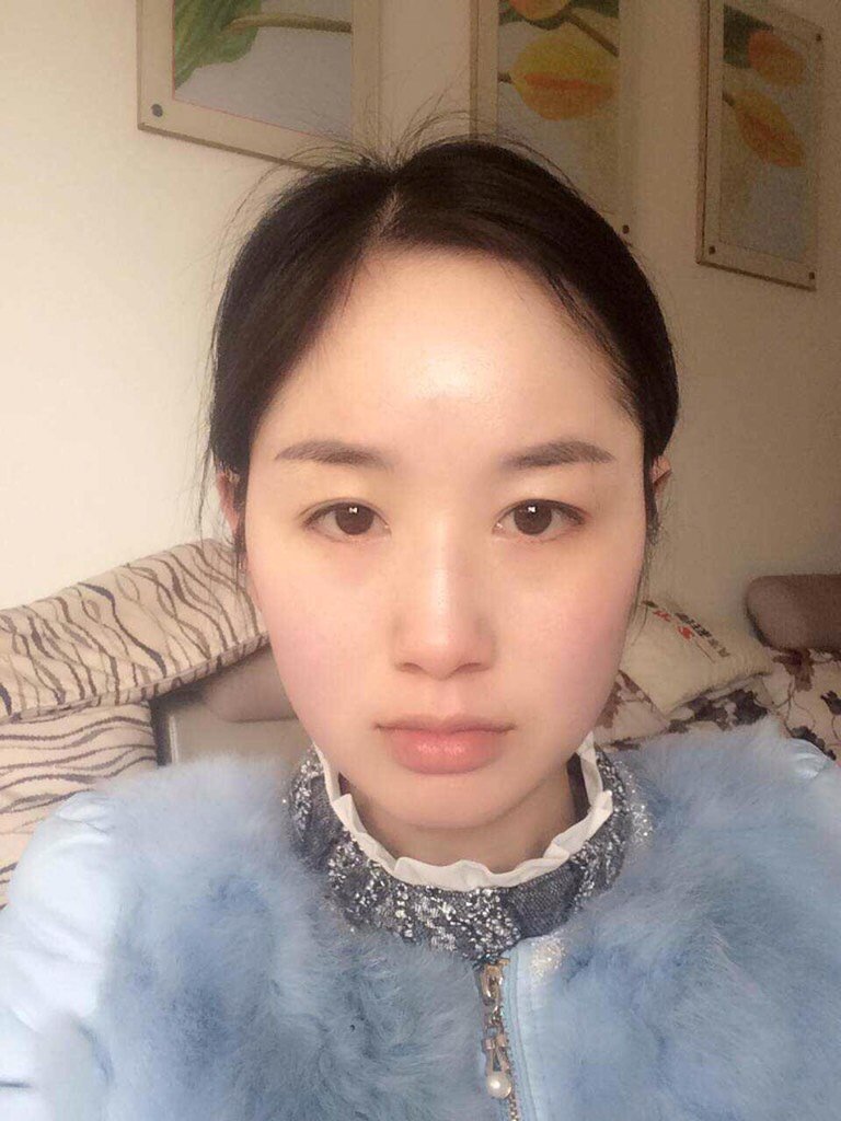 组织恢复期开内眼角第  天           ·           第1篇日记