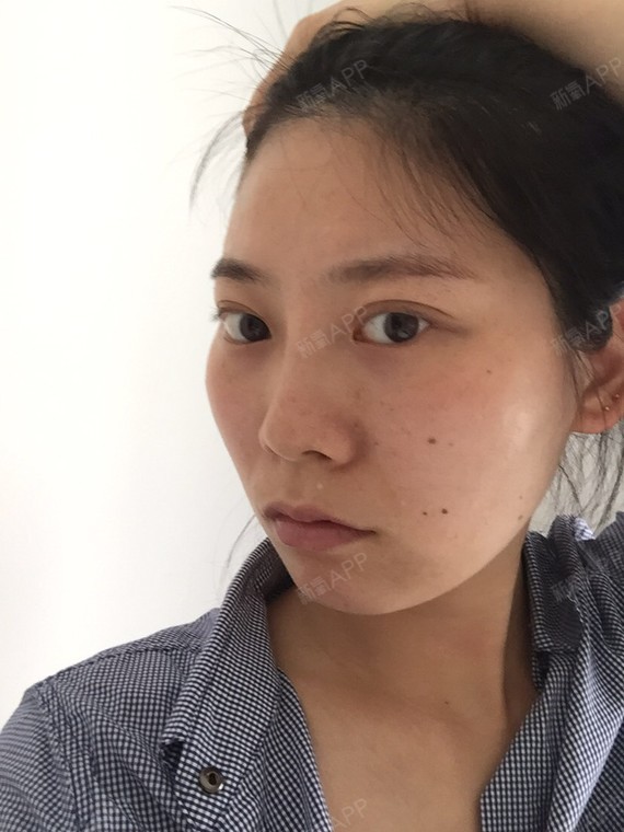 如果戴牙套会不会造成牙套脸导致颧骨更突出,