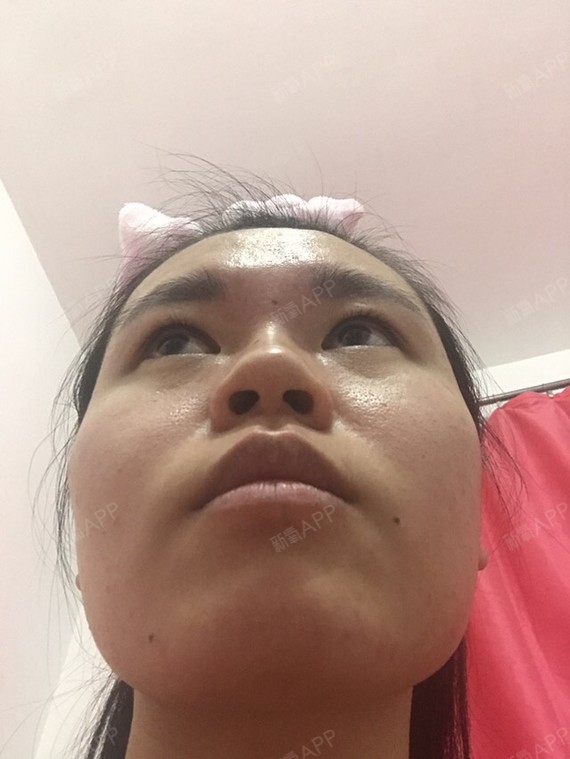 法令纹很深,应该调嘴和牙还是鼻基底?_圈子-新