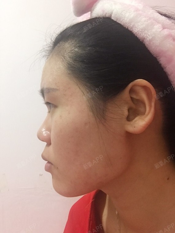 法令纹很深,应该调嘴和牙还是鼻基底?_圈子-新