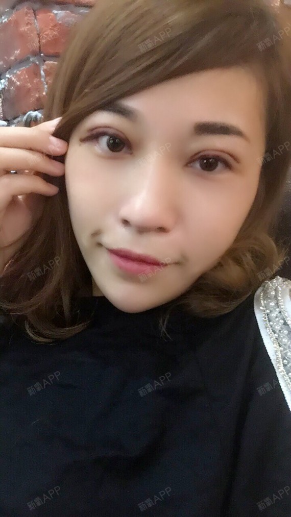 猫猫爱吃糖切开双眼皮第1天美丽日记-新氧美容