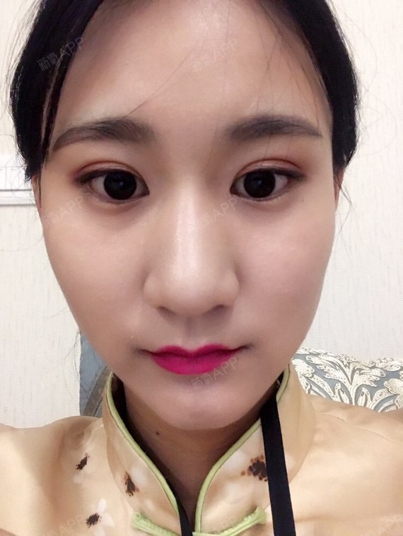 鼻部肥大 鼻骨特别宽 该怎么解决啊求告知!