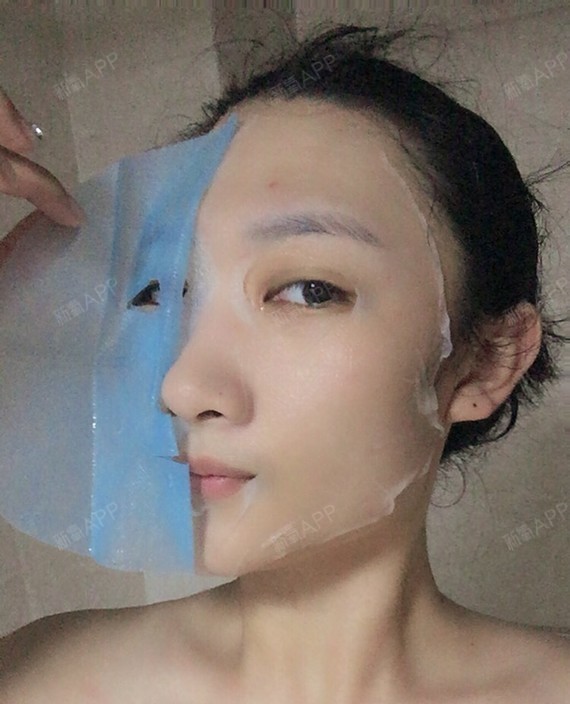 开了眼角已经三个月了,眼角的疤痕,增生还是挺