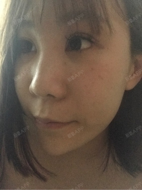 kianna激光美肤第2天美丽日记-新氧美容整形