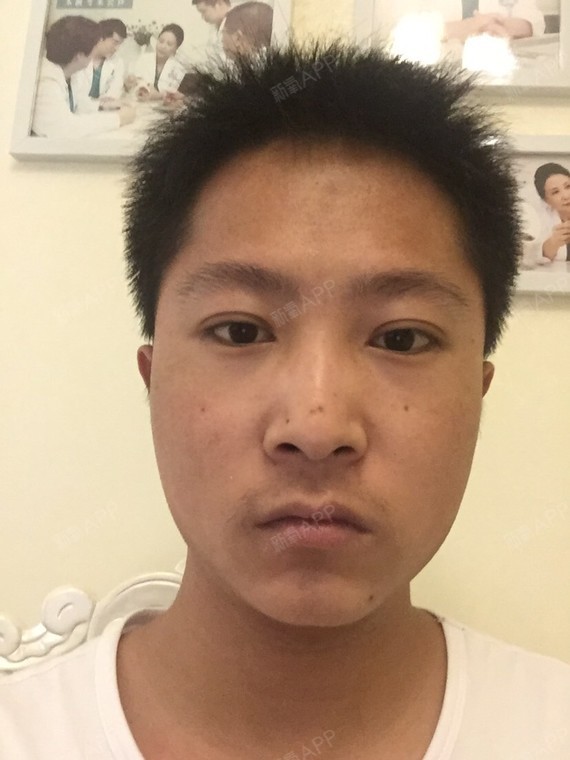 做完光子嫩肤第一天,感觉效果还不错.