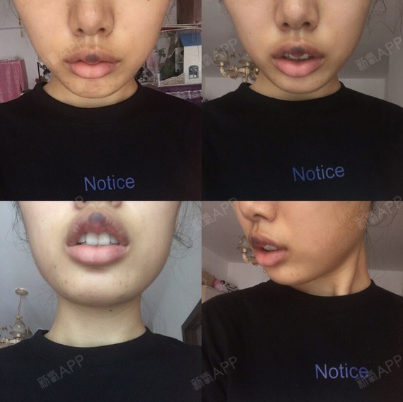 [day11]今天是手术后的第11天今天把唇珠的线_圈子