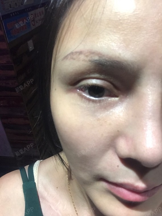 新氧- 氧气7739261503002032 | 眼部 | 开眼角 | 开外眼角 | 术后当
