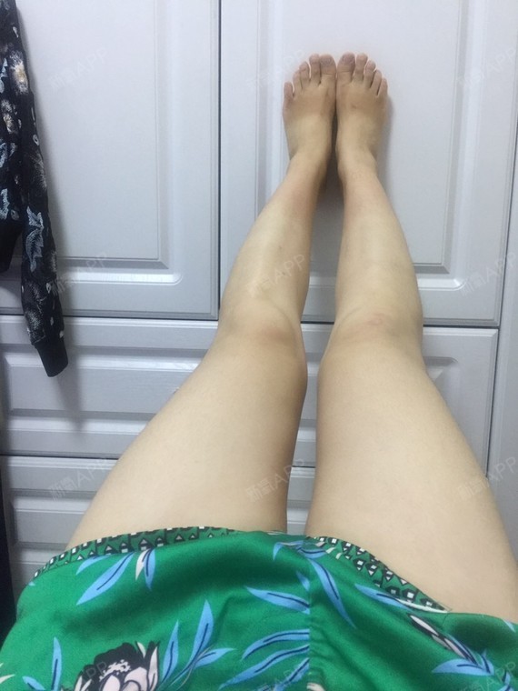 秦时明月依旧在冷冻溶脂瘦大腿第51天美丽日