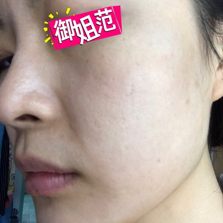 结痂脱落期点阵激光第  天           ·           第4篇日记