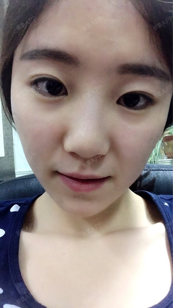 第2天小皮丘下去好多,不过针眼还是比较明显,周日在_圈子-新氧美容