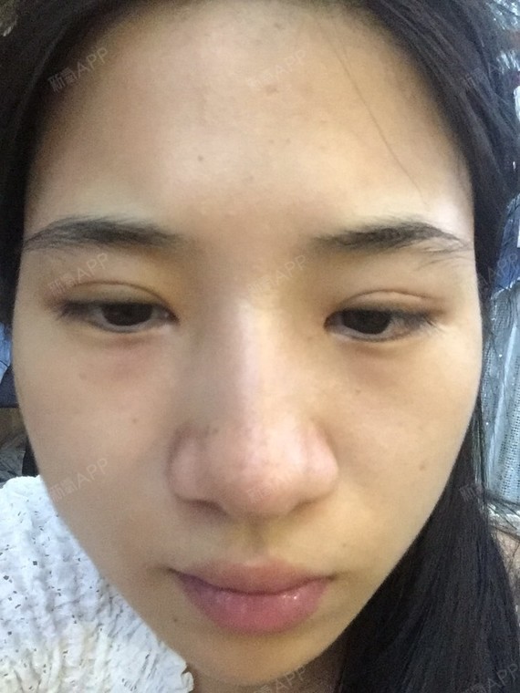 宁波 165 90 鼻子脸型倒三角有点凸嘴,全脸只做过眼睛,想告诉大家变美