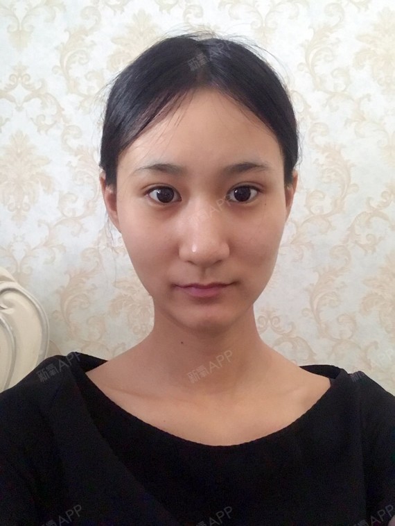 河北.本人170体重96颧骨大下颌角宽鼻子肥大想整_圈子-新氧美容整形