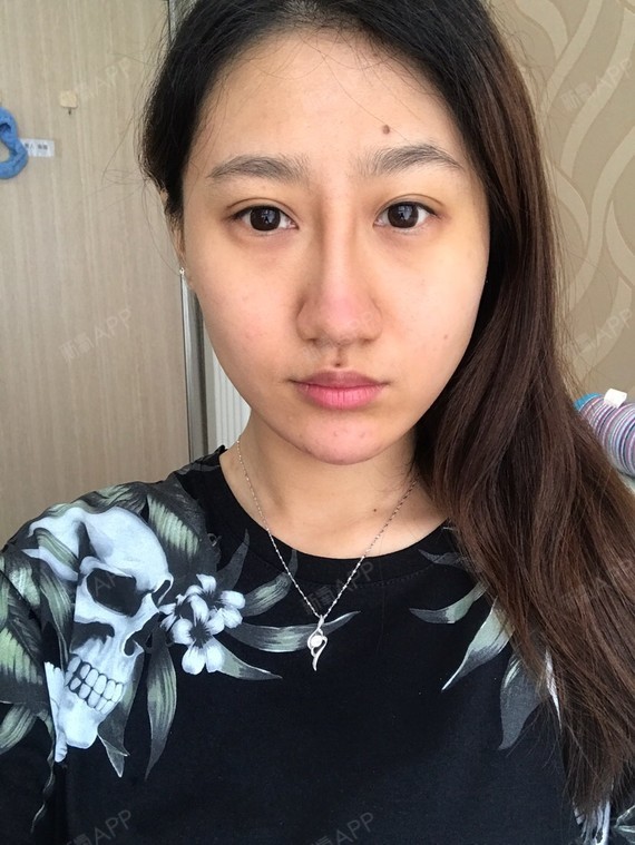 【玻尿酸鼻子和下巴】【手术当天】自恋的说其实我