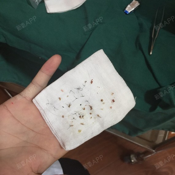 七天去拆线了 拆线的时候有一丢丢疼 而且拆的线比较多 时间也有点久