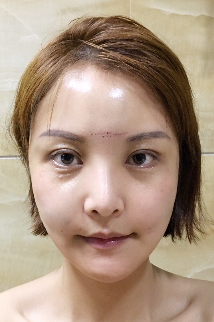 下眼下至术第14天