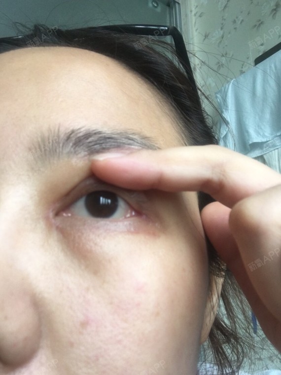眼睛做的项目比较多导致眼睛严重球结膜水肿充血之前的_圈子-新氧美容