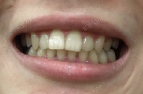 深覆合,上排牙总是盖住下排牙,上排牙门牙突出,该如何矫正