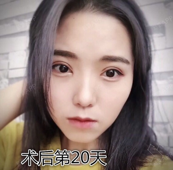 全切双眼皮适用对象:1,凡上眼睑皮肤垂帘于睑缘,不_圈子-新氧美容整形