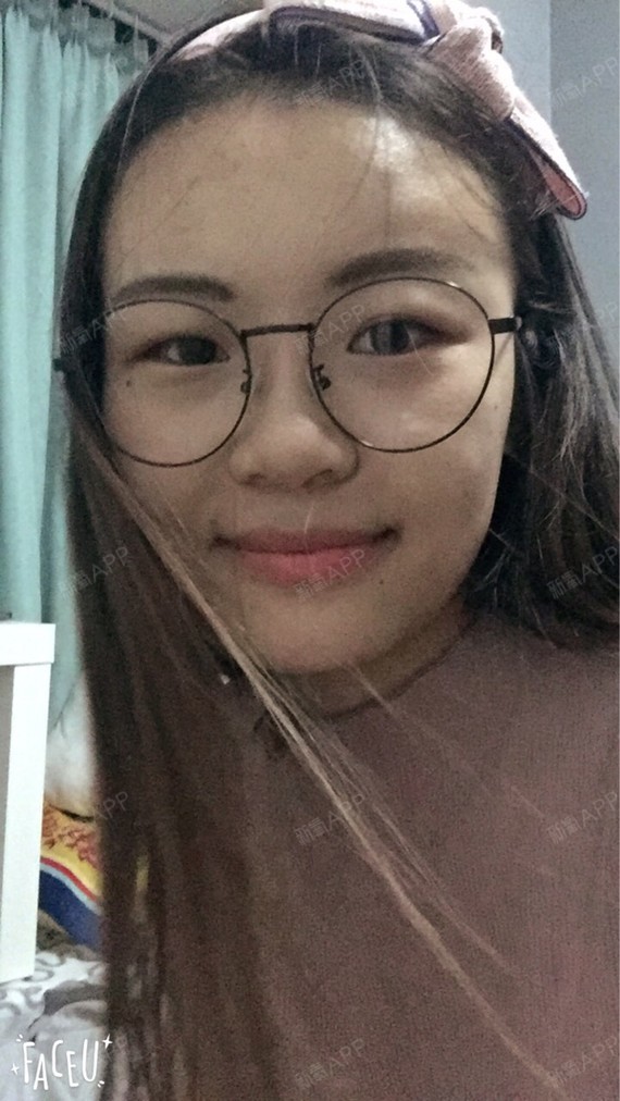 C苏丽珍自体脂肪填充脸颊第71天美丽日记-新