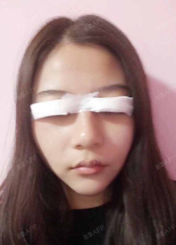 【切开双眼皮开外眼角】从小就一直被大人们夸眼睛大