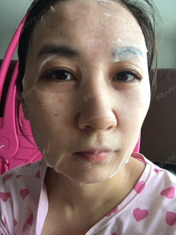 这是打完水光针24小时后了,拿生理盐水擦面后真的好_圈子-新氧美容