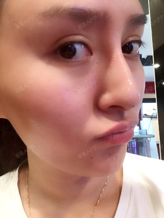 许多人喝水我都说我的脸比以前胖了.其实是没打瘦脸针的看见.关系胖怎么减肥瘦身图片