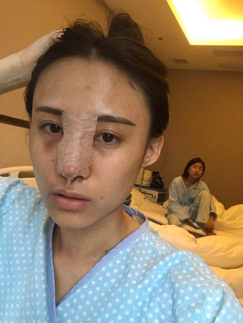 手术延长鼻小柱第1天
