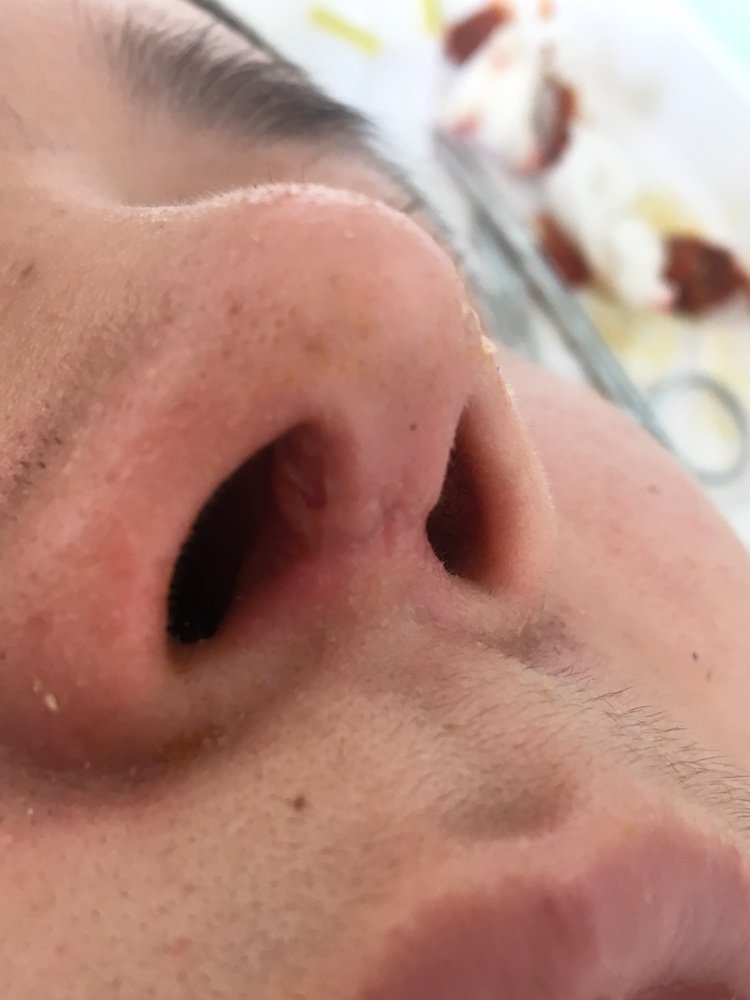 做肋软骨鼻综合拆线后发现鼻腔内软骨3毫米外露,怎么办?