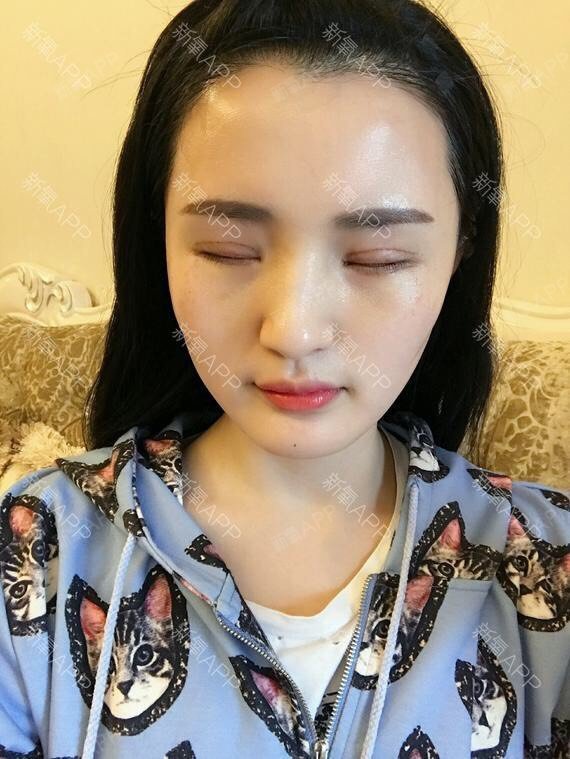 【重庆当代整形】阿尔法隐形双眼皮何为隐形阿