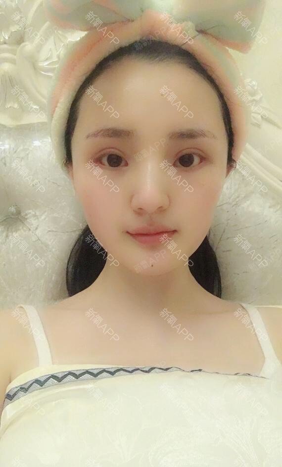 【重庆当代整形】阿尔法隐形双眼皮何为隐形阿