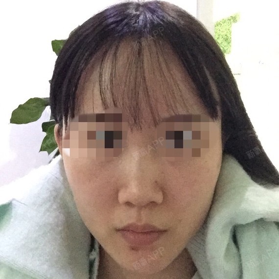 如上图所示嘴角一个上一个下,导致面部不对称