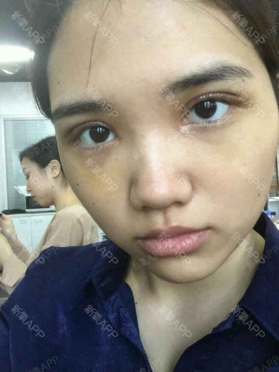 当代整形】阿尔法隐形双眼皮阿尔法:双眼皮呈