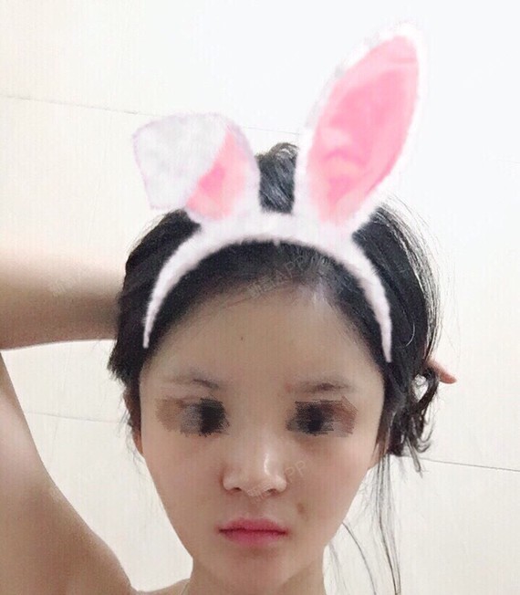 今天术后第五天 鼻梁还是像昨天那样特别肿 宽 ,嘴角有点淤青