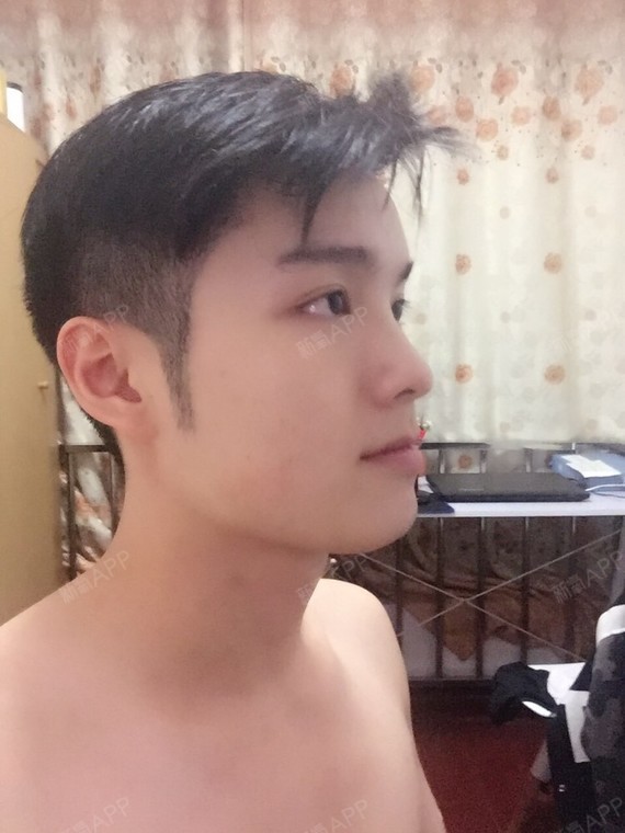 永远_550192种植发际线第337天美丽日记-新氧